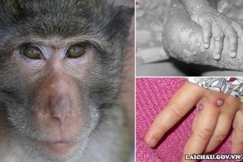 Nóng: Bộ Y tế ban hành hướng dẫn chẩn đoán, điều trị và phòng bệnh đậu mùa khỉ ở người