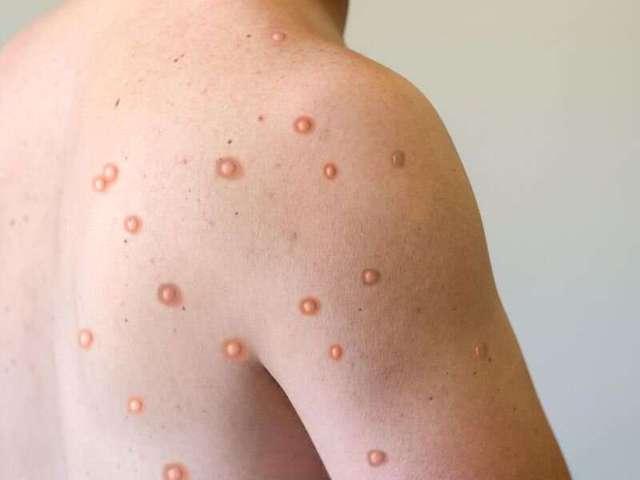 Vị trí phát ban của bệnh đậu mùa khỉ và zona có khác nhau? - Ảnh 2.