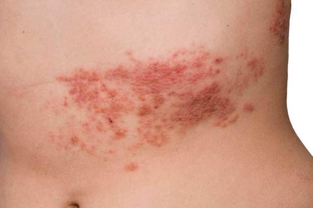 Vị trí phát ban của bệnh đậu mùa khỉ và zona có khác nhau? - Ảnh 4.