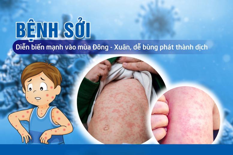 Thủ tướng yêu cầu tăng cường công tác phòng, chống bệnh sởi- Ảnh 1.