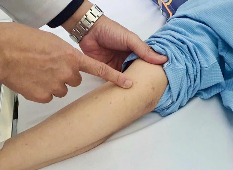 Phú Quốc ghi nhận ca nghi viêm màng não mô cầu, ngành y tế tăng cường giám sát và phòng ngừa- Ảnh 1.