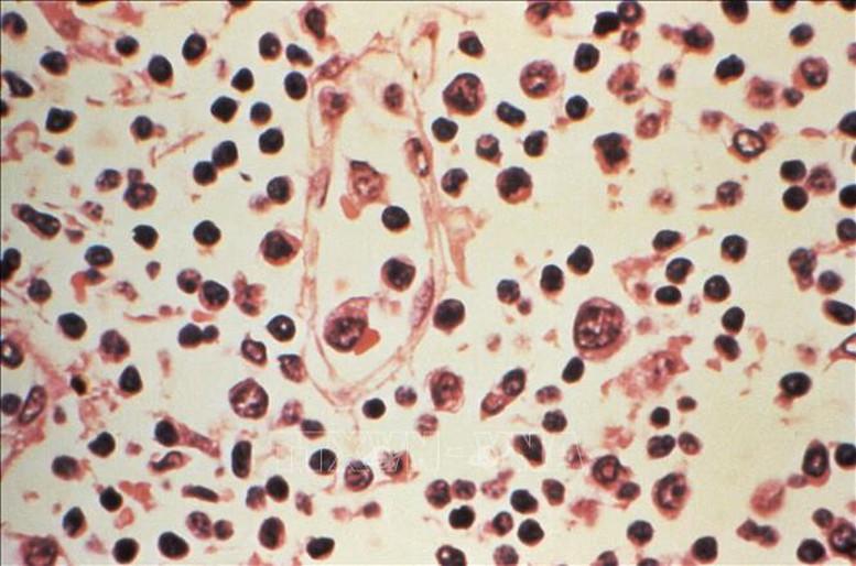Virus Hanta: Xác nhận 6 ca nhiễm, nguy cơ lây lan toàn cầu ở mức thấp- Ảnh 1.