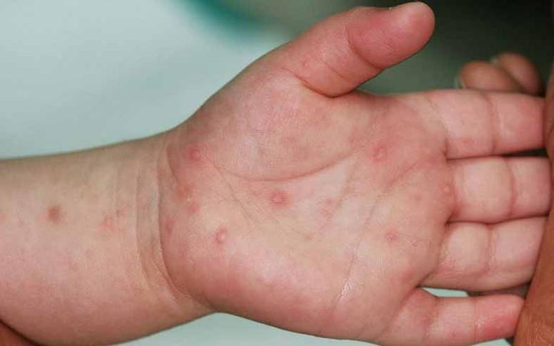 Ghi nhận 3.000 ca mắc tay chân miệng mỗi tuần, Bộ Y tế khuyến cáo khẩn- Ảnh 1.